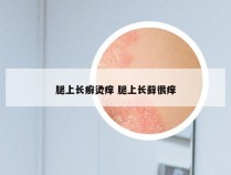 腿上长癣烫痒 腿上长藓很痒