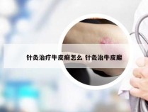 针灸治疗牛皮癣怎么 针灸治牛皮廨