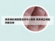 银屑病的病因看迎泽中心银屑 银屑病正规医院都在哪