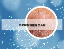 牛皮癣报销医保怎么报