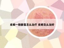 皮癣一般都是怎么治疗 皮癣怎么治好