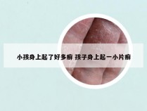 小孩身上起了好多癣 孩子身上起一小片癣