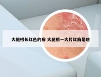 大腿根长红色的癣 大腿根一大片红癣是啥