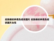 皮肤癣的种类及症状图片 皮肤癣的种类及症状图片女性