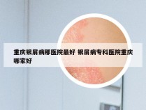 重庆银屑病那医院最好 银屑病专科医院重庆哪家好