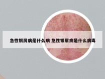 急性银屑病是什么病 急性银屑病是什么病毒