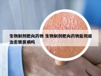 生物制剂靶向药物 生物制剂靶向药物能彻底治愈银屑病吗