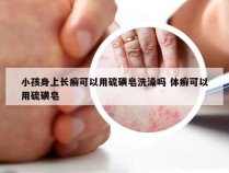 小孩身上长癣可以用硫磺皂洗澡吗 体癣可以用硫磺皂