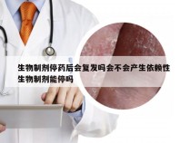 生物制剂停药后会复发吗会不会产生依赖性 生物制剂能停吗