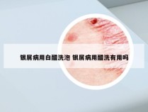 银屑病用白醋洗泡 银屑病用醋洗有用吗