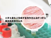 八岁儿童头上生癣歹复发作怎么治疗 8岁儿童长头皮屑怎么办