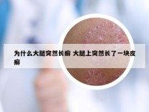 为什么大腿突然长癣 大腿上突然长了一块皮癣