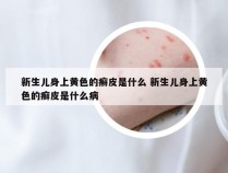 新生儿身上黄色的癣皮是什么 新生儿身上黄色的癣皮是什么病