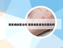 银屑病掉眉毛吗 银屑病患者有纹眉的吗