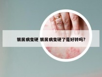 银屑病变硬 银屑病变硬了是好转吗?