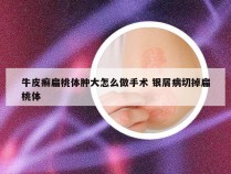 牛皮癣扁桃体肿大怎么做手术 银屑病切掉扁桃体