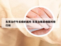 东莞治疗牛皮癣的医院 东莞治银屑病医院排行榜