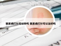 银屑病打针可以停吗 银屑病打针可以治好吗