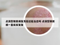 点滴型银屑病复发后还能治愈吗 点滴型银屑病一直反反复复