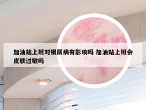 加油站上班对银屑病有影响吗 加油站上班会皮肤过敏吗