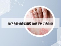 腋下有类似癣的图片 腋窝下长了类似藓