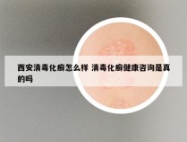 西安清毒化癣怎么样 清毒化癣健康咨询是真的吗