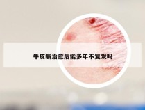 牛皮癣治愈后能多年不复发吗