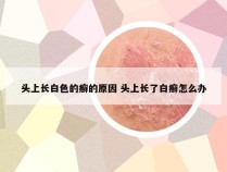 头上长白色的癣的原因 头上长了白癣怎么办