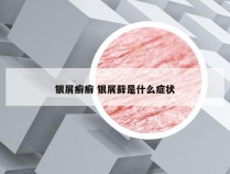 银屑癣癣 银屑藓是什么症状