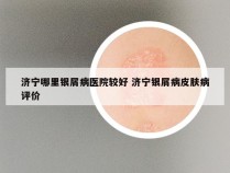 济宁哪里银屑病医院较好 济宁银屑病皮肤病评价