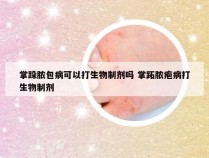 掌跺脓包病可以打生物制剂吗 掌跖脓疱病打生物制剂