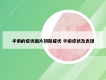 手癣的症状图片初期症状 手癣症状及表现