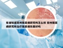 有谁知道郑州银屑病研究所怎么样 郑州银屑病研究所治疗银屑病效果好吗