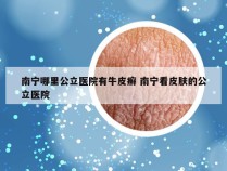 南宁哪里公立医院有牛皮癣 南宁看皮肤的公立医院