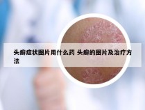 头癣症状图片用什么药 头癣的图片及治疗方法