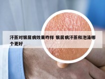 汗蒸对银屑病效果咋样 银屑病汗蒸和泡澡哪个更好