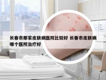 长春市那家皮肤病医院比较好 长春市皮肤病哪个医院治疗好