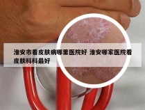 淮安市看皮肤病哪里医院好 淮安哪家医院看皮肤科科最好