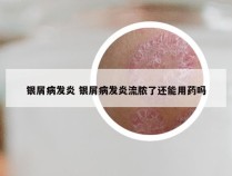 银屑病发炎 银屑病发炎流脓了还能用药吗