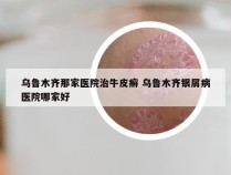 乌鲁木齐那家医院治牛皮癣 乌鲁木齐银屑病医院哪家好