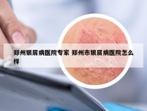 郑州银屑病医院专家 郑州市银屑病医院怎么样