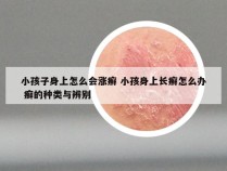 小孩子身上怎么会涨癣 小孩身上长癣怎么办 癣的种类与辨别