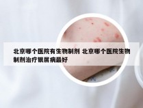 北京哪个医院有生物制剂 北京哪个医院生物制剂治疗银屑病最好