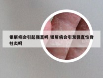 银屑病会引起强直吗 银屑病会引发强直性脊柱炎吗