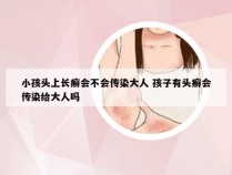 小孩头上长癣会不会传染大人 孩子有头癣会传染给大人吗