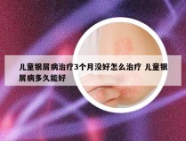 儿童银屑病治疗3个月没好怎么治疗 儿童银屑病多久能好