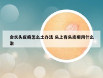 会长头皮癣怎么土办法 头上有头皮癣用什么治