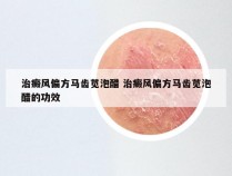 治癜风偏方马齿苋泡醋 治癜风偏方马齿苋泡醋的功效