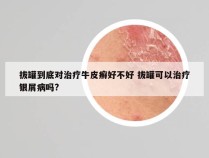 拔罐到底对治疗牛皮癣好不好 拔罐可以治疗银屑病吗?