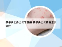 孩子头上身上长了皮癣 孩子头上长皮癣怎么治疗